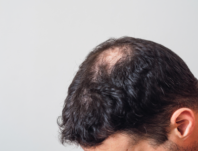 Phenylalanine for Hair Growth: Mechanism of Action
