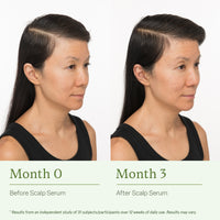 Scalp Serum + Free Travel-Sized Dry Shampoo